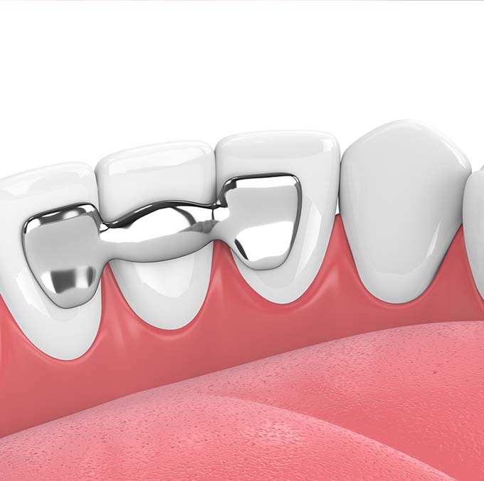 dental bridges