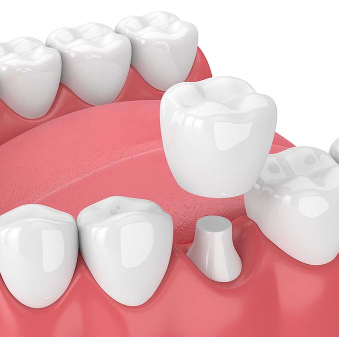 dental crowns