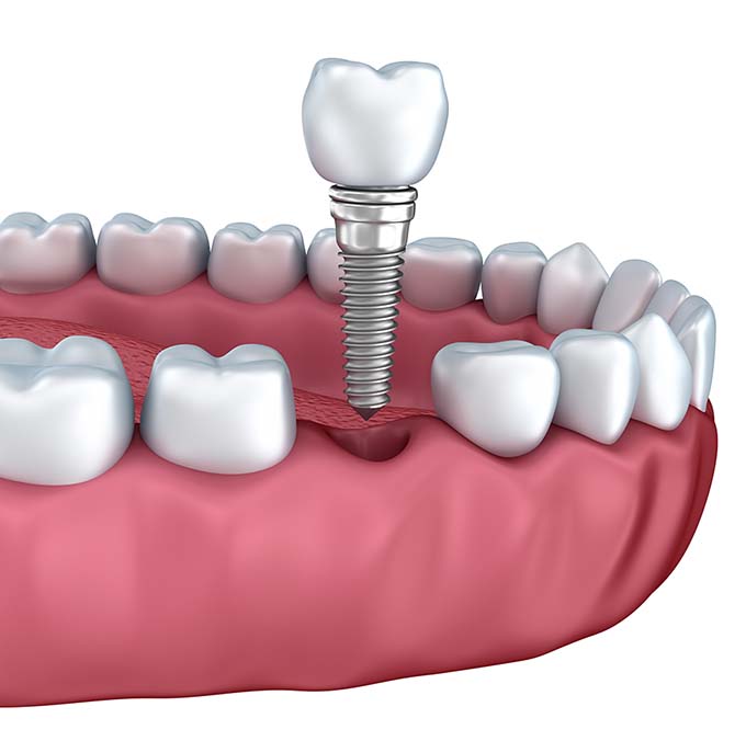 Dental Implants