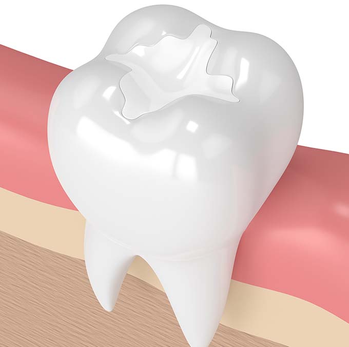 fillings
