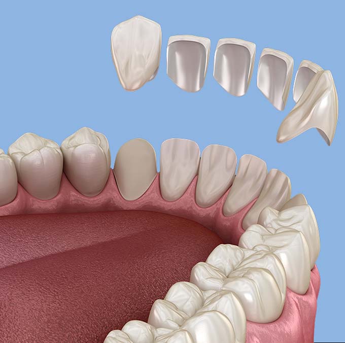 Porcelain Veneers